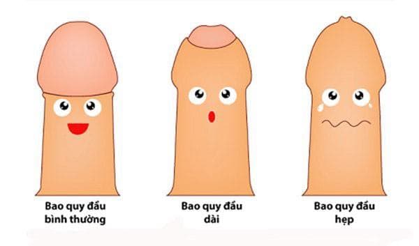 Hẹp bao quy đầu là một trong những bệnh lý thường gặp ở dương vật