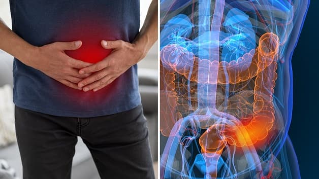 Bệnh ung thư đại tràng giai đoạn cuối là gì?