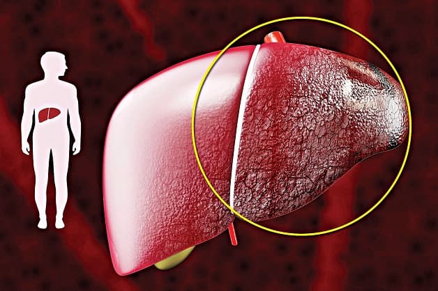 Bệnh xơ gan là gì?