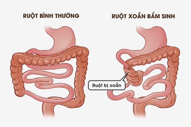Xoắn ruột là gì?| Biểu hiện và điều trị