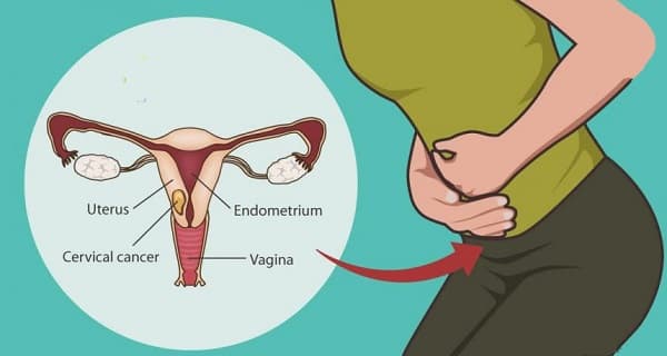 Khoảng 4.7 – 10.2% phụ nữ bị sùi mào gà ở cổ tử cung có thể tiến triển thành ung thư cổ tử cung