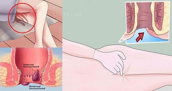 Khoảng 5% bệnh nhân sùi mào gà bị ung thư hậu môn 