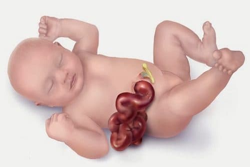 Xoắn ruột là một cấp cứu nội, ngoại khoa nguy hiểm có thể gây tử vong nếu không được phát hiện sớm và cấp cứu kịp thời đúng cách.