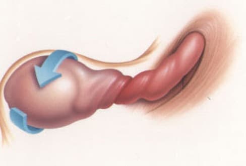 Thời điểm vàng để điều trị xoắn ruột là 6 tiếng tính từ khi có các triệu chứng của bệnh. 