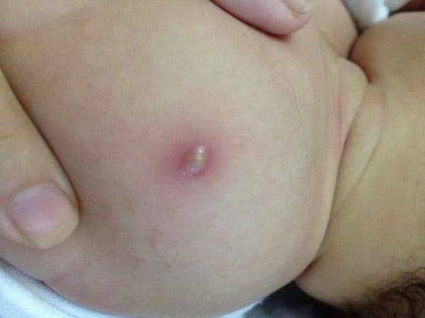 Tuy nhiên nhọt là những khối viêm cấp tính do liên cầu, tụ cầu, có khối trắng ở giữa (mủ).