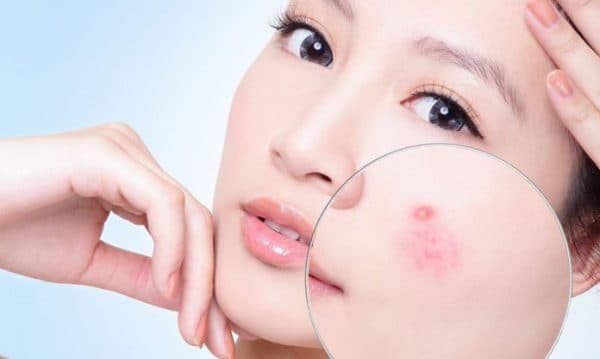 Các loại mụn thường là mụn trứng cá, bọc trứng cá hay sần trứng cá hay gặp ở những thanh niên dậy thì