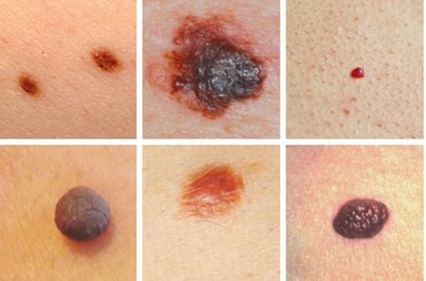 Dấu hiệu của bệnh ung thư da là gì