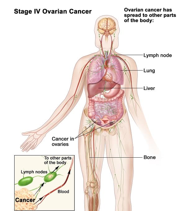 Ung thư buồng trứng giai đoạn cuối có khả năng di căn rộng đến các cơ quan như xương, phổi...