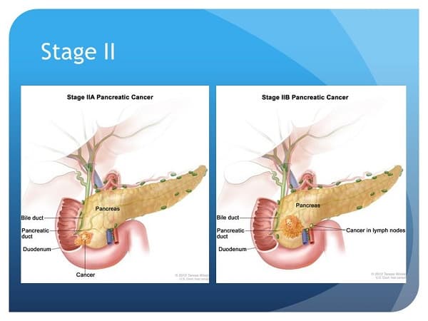 Ung thư tuyến tụy giai đoạn II