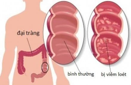Các bệnh lý ở đại tràng, tá tràng là nguyên nhân gây đầy bụng đi ngoài