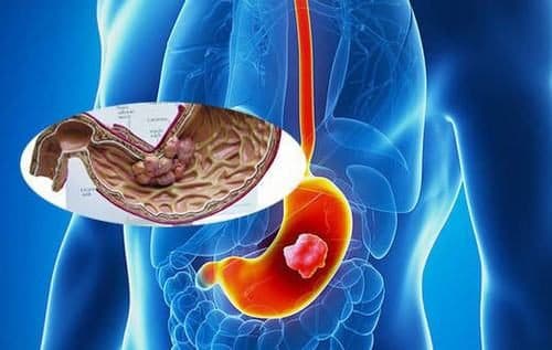 Ung thư dạ dày là bệnh khá phổ biến trong 10 loại ung thư thường gặp nhất. 