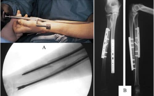 Kết xương bằng nẹp vít là phương pháp phẫu thuật xương khớp thường được áp dụng tại các bệnh viện lớn, mang lại hiệu quả cao