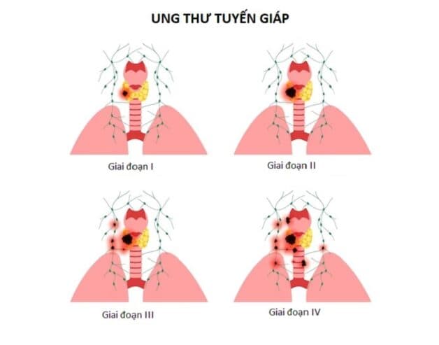 Ung thư tuyến giáp dạng thể nhú có nguy hiểm không?