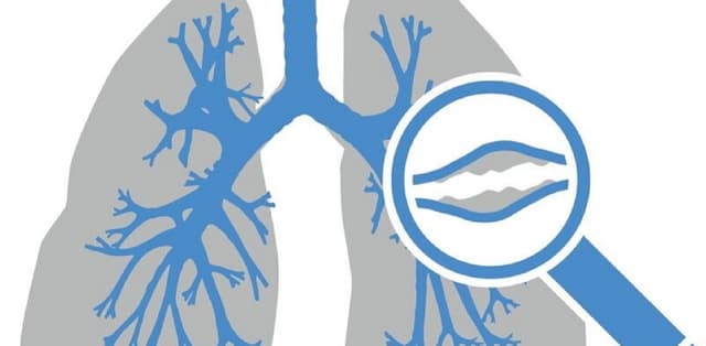 Giãn phế quản thể khô là gì?