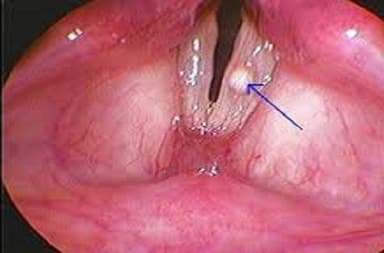 Hạt xơ dây thanh quản chữa như thế nào?