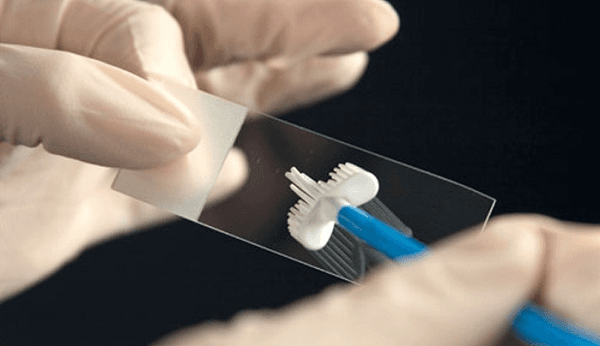 Pap smear phát hiện những bất thường sớm ở cổ tử cung