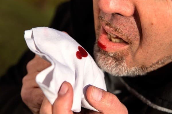 Ho ra máu cũng là biểu hiện thường gặp ở bệnh nhân ung thư phổi