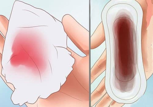 Xuất huyết âm đạo bất thường là một trong những triệu chứng ung thư cổ tử cung điển hình