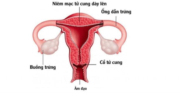 Chị em có biết: &#8220;Niêm mạc tử cung dày bao nhiêu