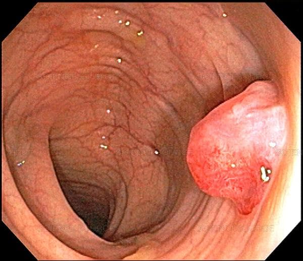 Nội soi trực tràng phát hiện được các polyp và loại bỏ ngăn ngừa ung thư