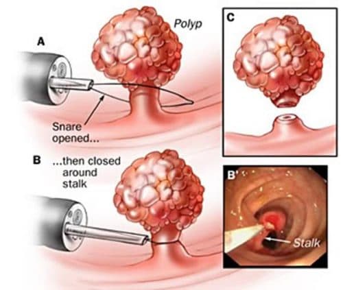 Nguy cơ tiến triển thành ác tính của polyp trực tràng phụ thuộc vào kích thước của khối polyp.