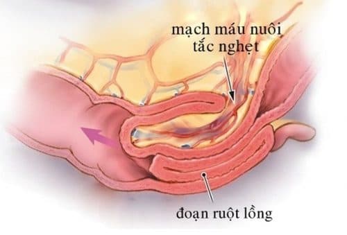 Lồng ruột là một trong những nguyên nhân gây tắc ruột cơ học