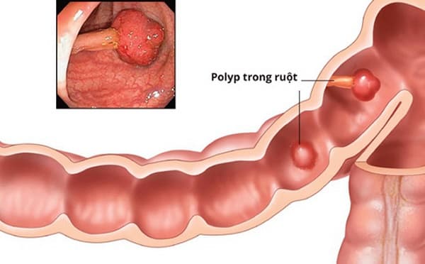 Polyp đại tràng là bệnh gì