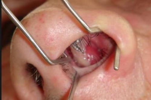 Polyp mũi nguy hiểm không? ảnh hưởng đến sức khỏe