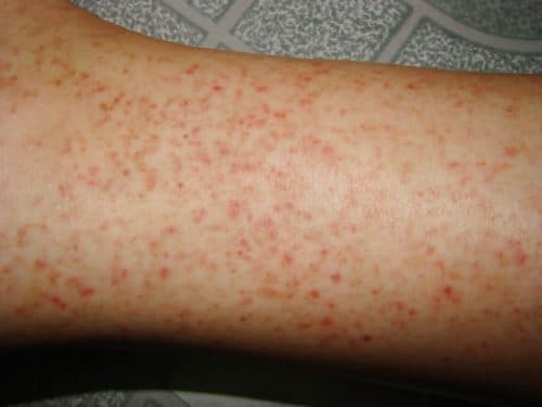 Sốt xuất huyết giảm tiểu cầu là tình trạng nguy hiểm cần phải được chăm sóc y tế kịp thời, đúng cách.