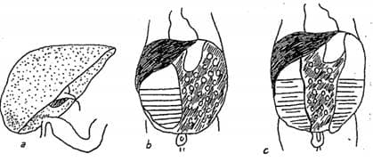 Các loại viêm phúc mạc bào thai: a. Viêm phúc mạc dính; b. Viêm phúc mạc thai nhi kết bọc, hình thành nang giả; c. Viêm phúc mạc kết bọc, viêm phúc mạc phân su.