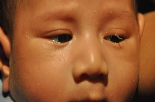 Tắc tuyến lệ có nguy hiểm không, cùng tìm hiểu nguyên nhân