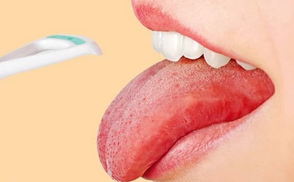 Thông tin về ung thư lưỡi ai cũng nên biết