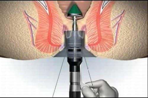 Phẫu thuật cắt trĩ longo là phương pháp tối ưu trong điều trị bệnh trĩ hiệu quả