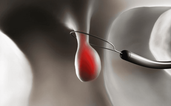 một người có thể có nhiều polyp đại tràng với kích thước khác nhau và nguy cơ chuyển thành ác tính cũng khác nhau