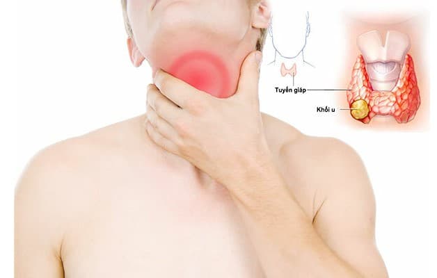 Ung thư tuyến giáp dạng thể nhú sống được bao lâu?