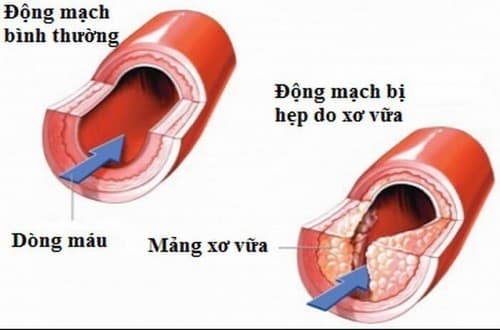 Triệu chứng xơ vữa động mạch là gì?