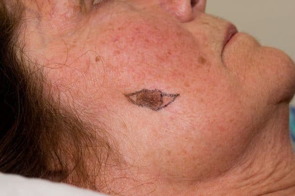 U hắc tố là gì