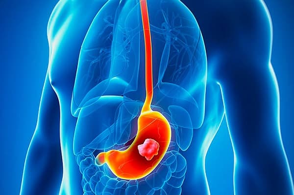 Ung thư dạ dày giai đoạn cuối có khả năng di căn rộng đến các cơ quan ở xa