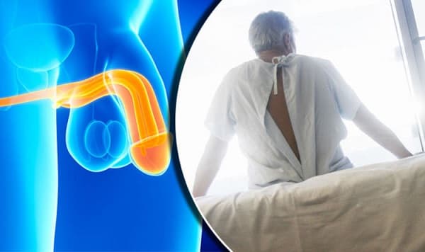 Ung thư dương vật là một trong những bệnh ung thư thường gặp ở nam giới, đặc biệt là các nước kém phát triển