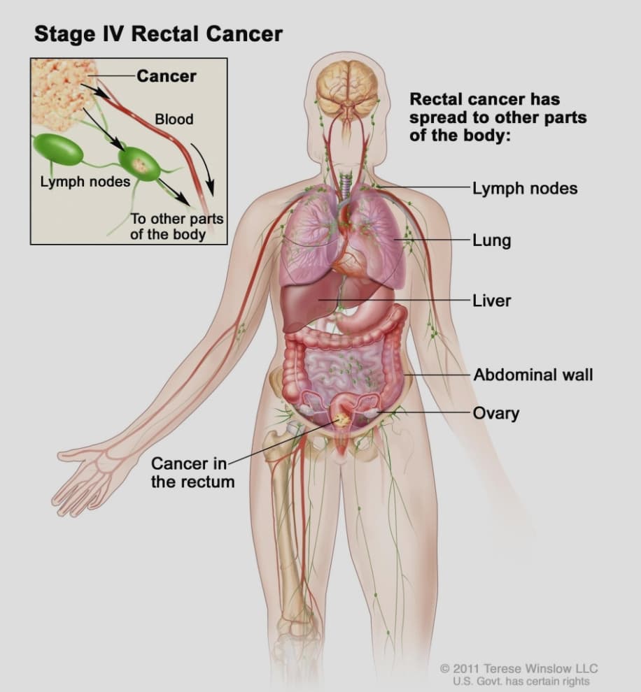 Ung thư trực tràng di căn gan
