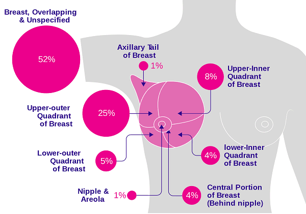 Ung thư vú có mấy loại