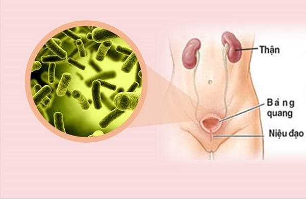 Viêm bàng quang thường gặp ở nữ 