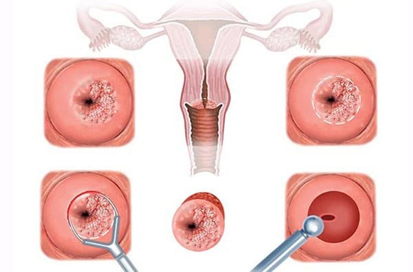 Tùy từng tình trạng cụ thể mà bác sĩ sẽ chỉ định phương pháp điều trị viêm lộ tuyến cụ thể
