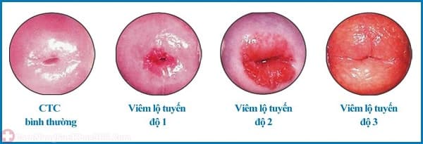 Các mức độ viêm lộ tuyến cổ tử cung