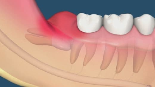 viem-loi-trum-la-gi-1