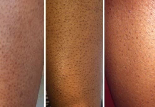 Nguyên nhân phổ biến nhất của viêm nang lông là vi khuẩn Staphylococcus Aureus (đa số là tụ cầu trùng)