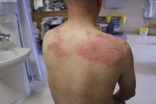 tác dụng phụ của xạ trị ung thư trực tràng