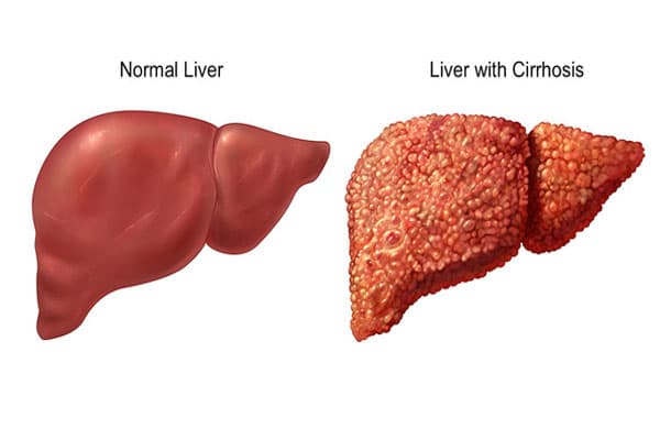 Do các tế bào gan tổn thương không đồng đều nên có một số tế bào gan vẫn hồi phục được phẩn nào