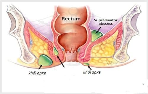 Apxe hậu môn là bệnh lý hậu môn trực tràng thường gặp
