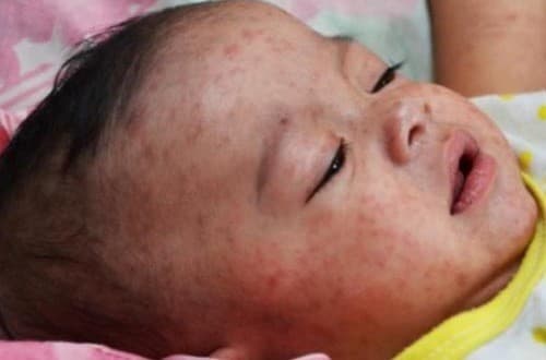 Biểu hiện bệnh sởi ở trẻ